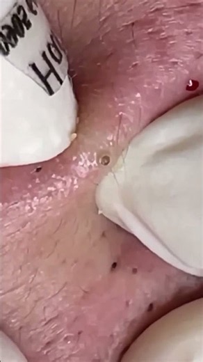 Blackhead Removal Videos Ever | VET Spa 4K #001