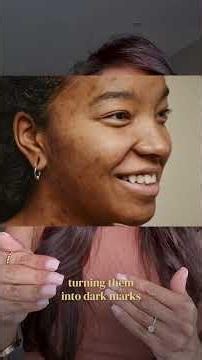 How To Treat Acne