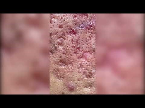 Satisfying Pimple Popping & Cyst Extractions - 228