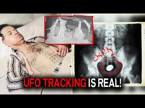He was RETURNED with 22 BURNS and an object in the RECTUM – a crazy UFO abduction story