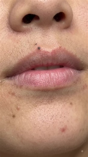 How to Remove Blackheads from Lips Safely