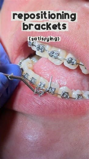 Repositioning Brackets 🤩🔥 (Satisfying) Tooth Time Family Dentistry