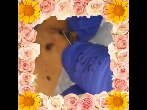 Blackheads Removal #607 | Acne Treatment and Very Satisfying Satisfying Pimple pop #blackheads
