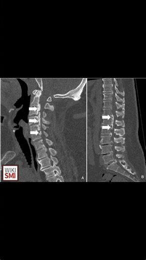 Posterior Longitudinal Ligament 🧠 | Spine Anatomy & Function #anatomy #spine #chiropractor #atc