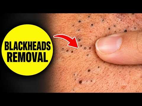 sac dep spa blackhead removal | blackheads new this week #5789