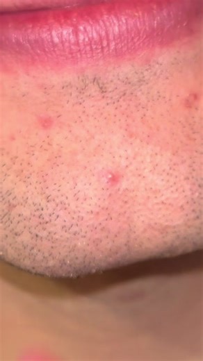 Elegant Whitehead and Blackhead Removal Techniques