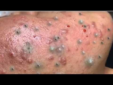 Deep blackhead Removal 2026, acne removal spa, big pimple 2026, #acne #pimple #cyst