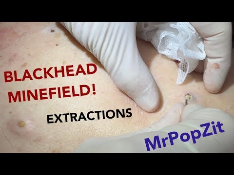 Gigantic Blackhead Minefield! Imbedded stones in the back with multiple cysts.Blackhead Extractions