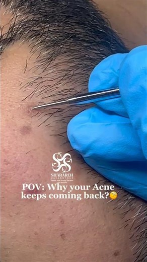 Why your acne keeps coming back? #acnescars #skincare #poreminimization #glowskin