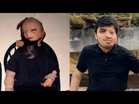 Texas Man Survives Childhood Fire That Burned 65% of His Body