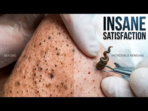 Deep Blackhead and Pimple Removal - Best Satisfying Moments!