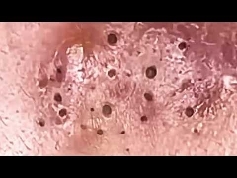 Blackheads & Whiteheads Satisfying Removal Acne and Pimple @08154