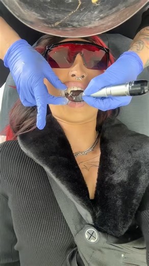 How those viral vampire teeth trends actually work | TheBentistofficial