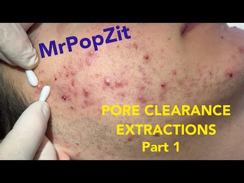 Inflammatory acne extracted. See the meticulous procedure close up and his path to clearance! 