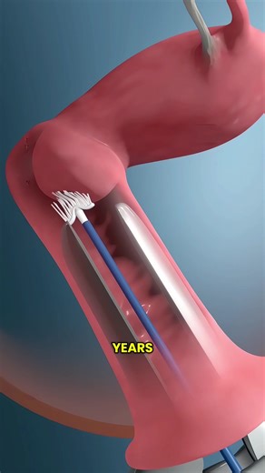 Intrauterine Device For Birth Control#iud #pregnancy #intrauterinedevice #birthcontrol #iudinsertion