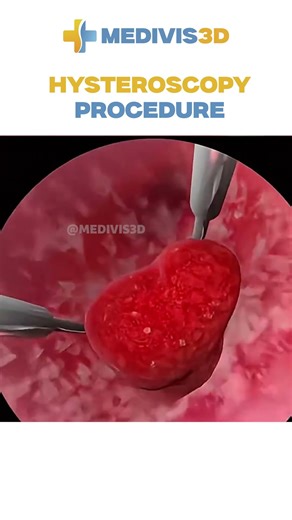 Hysteroscopy Procedure – 3D Animation Explained Step by Step