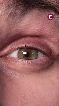 Detectan posible causa celular del ojo seco