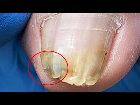 There Is Treasure Under The Toenails! Clean It Carefully【Xue Yidao】