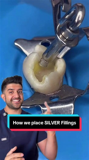 How we place Silver (Amalgam) Fillings 😁🦷 #amalgam #fillings #silverfilling #dentist #doctor