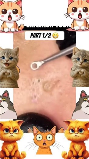 Insane Pimple Popping!!!