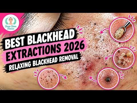 Best Blackhead Extractions 2026| Relaxing Blackhead Removal