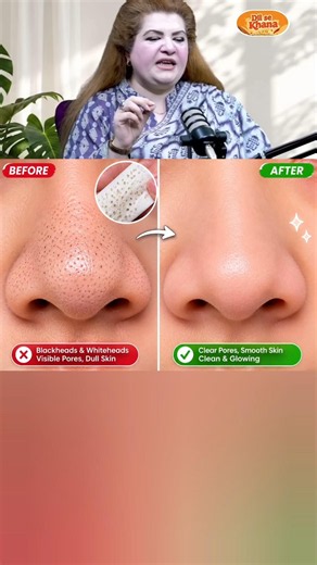 Remove Blackheads & Whiteheads with Egg White Mask |DIY Nose Peel-Off #ytshorts #shorts #fyp #beauty