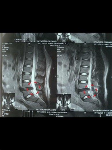3 months of back pain