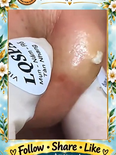 Deep Blackhead Extraction & Satisfying Popping | Wait for the most satisfying pop 😳🫣 You won’t believe what comes out! #pimplepoppersatisfying #Acne #pimple #Blackhead #Satisfying