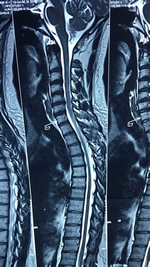 C5,C6,C7 spinal cord compression #xray #anatomy #nervecompression #ayurved spinalcordcompression