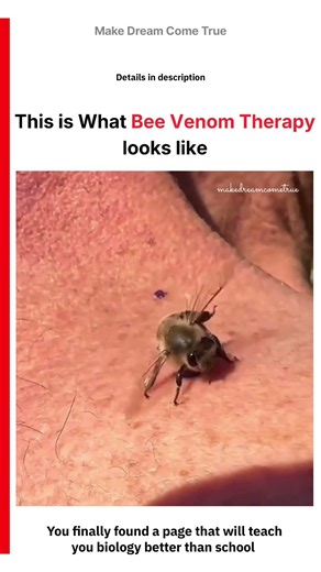 🐝 This is What Bee Venom Therapy ⚡ Looks Like | MDCT