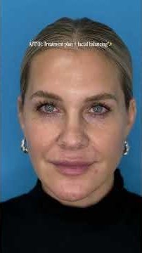 “I Look Like I Slept SO Well” | Full Injectable Plan + Patient Reaction ✨