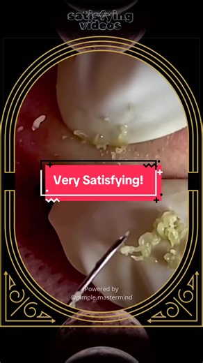 Blackheads removal at SPA Skincare Satisfying Video #blackheadsremoval #blackhead #acnetreatment #skincare #satisfying