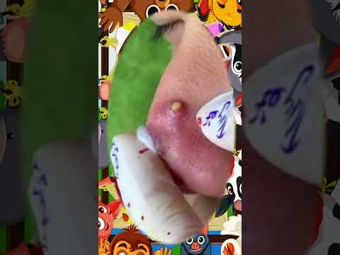 Blackheads Removal #651 | Acne Treatment and Very Satisfying Satisfying Pimple pop #blackheads