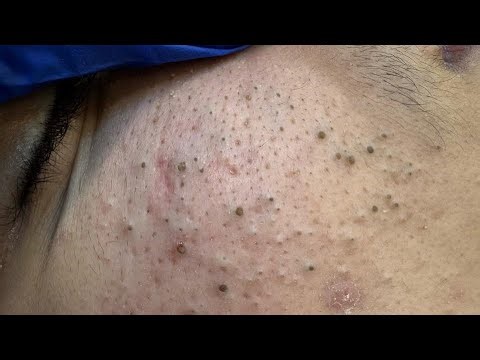 [ASMR] Blackheads Removal and Deep Pore Minimizing Solutions