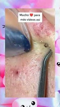 Insane Pimple Popping!!!