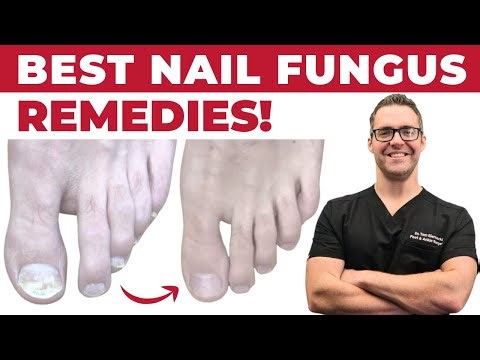Top 10 Home Remedies For Toenail Treatment in 2024 [Simple Fix You Haven’t Tried]