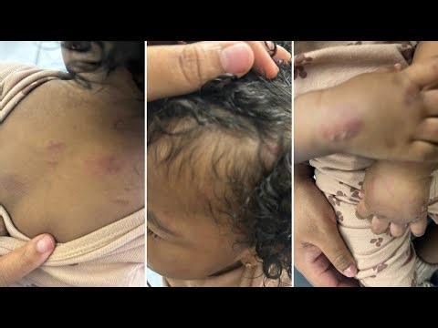 Detroit mom says 1-year-old bitten and bruised at child care center