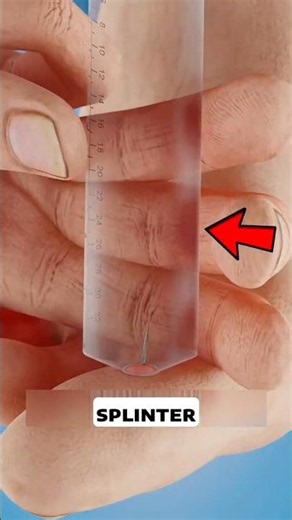 Never Remove a Splinter Like This! 😱 (Do THIS Instead!)