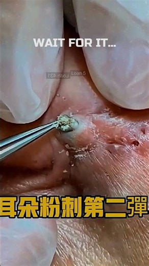 Removing large blackheads and pimples from face new 2026 #101