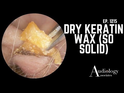 Hard Ear Wax Plug Removal With Oil Lubrication and Hook Extraction - EP1215