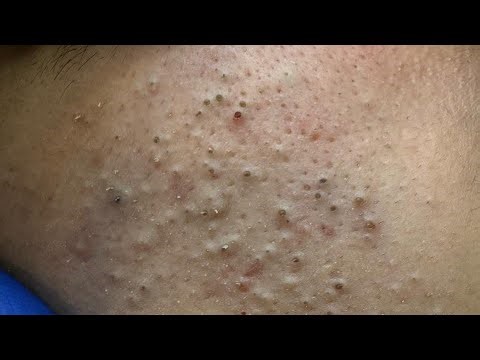 Deep Cleansing Techniques - Blackheads and Whiteheads Removal || Facial Care Routine