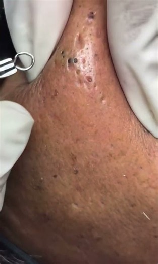Blackhead extracting 🫣 #acne #pimplepopping #blackheads #fyp #xyzbca