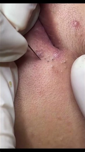 Biggest amount of blackheads i’ve ever seen in one ear😱🤤😱