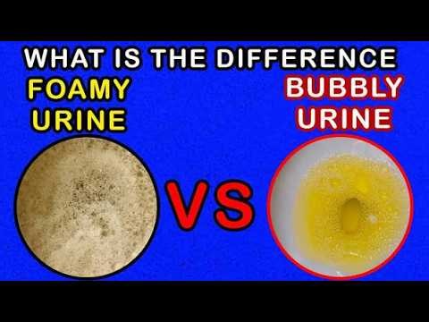 Foamy or bubbly urine Or Frothy Urine ; Definition, Causes, Symptoms, Diagnosis, treatment