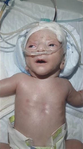 premature baby 32 week preterm