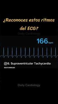 ¿Reconoces estos ritmos del ECG?