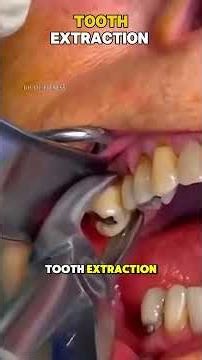 How Tooth Extraction Surgery Is Done (3D Animation) #medicalanimation#fyp #educationalconten