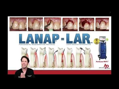 Case 17-LANAP Treatment Planning