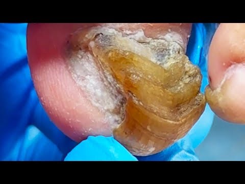 Will Extremely Thick Onychomycosis Tore Through Socks【Podiatry Clinic】