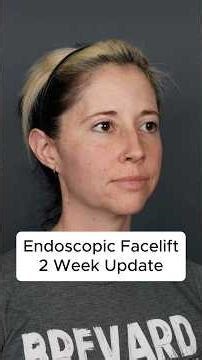 Endoscopic Deep Plane Facelift At 42 - 2 Week Update #facelift